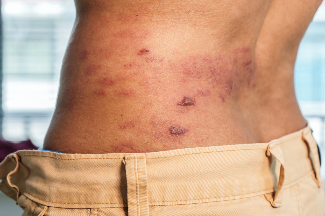 Herpes-zóster: o que é, sintomas, tratamento e prevenção