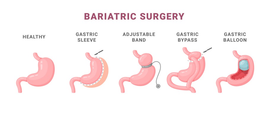 Tipos de cirurgia bariátrica